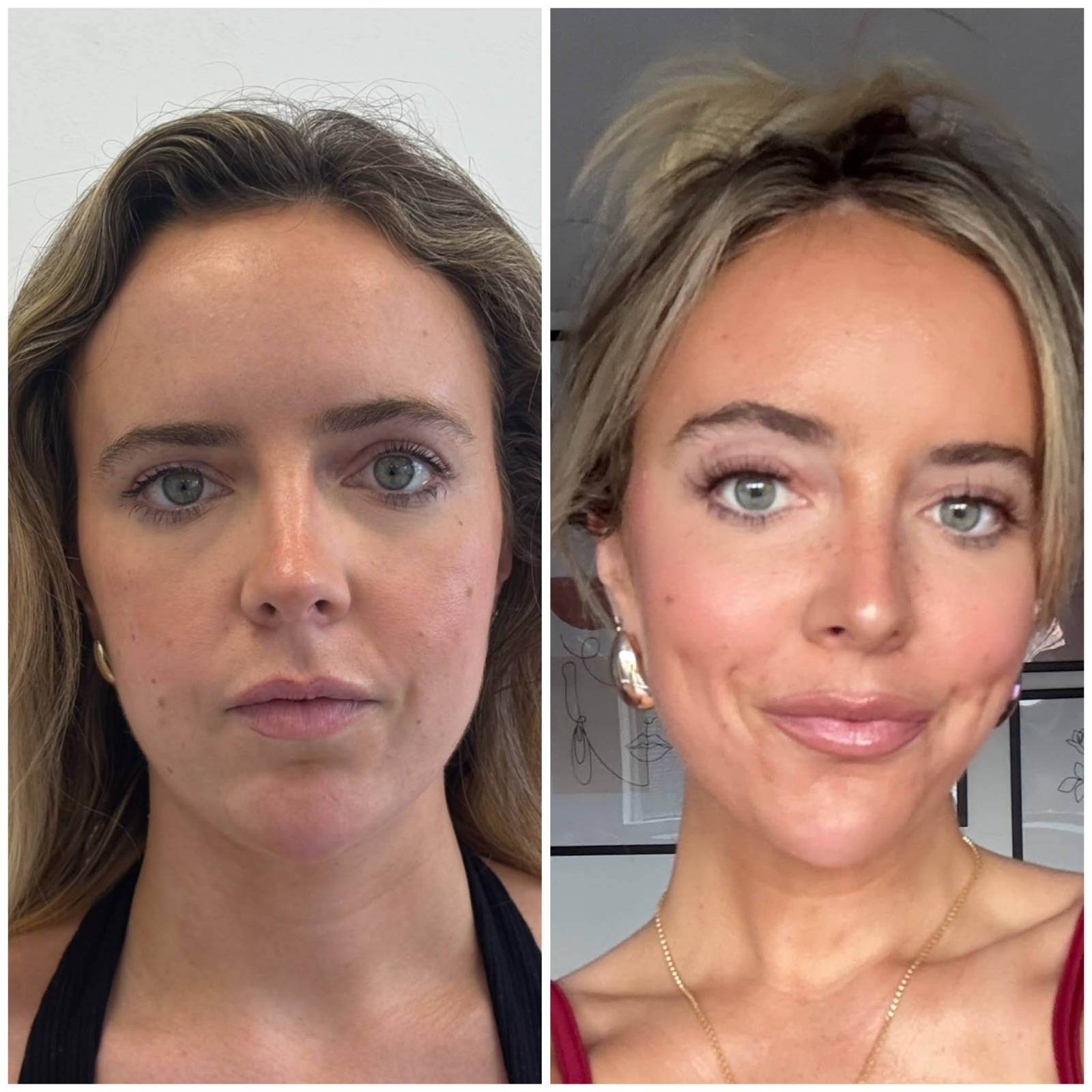 Full Face Lift