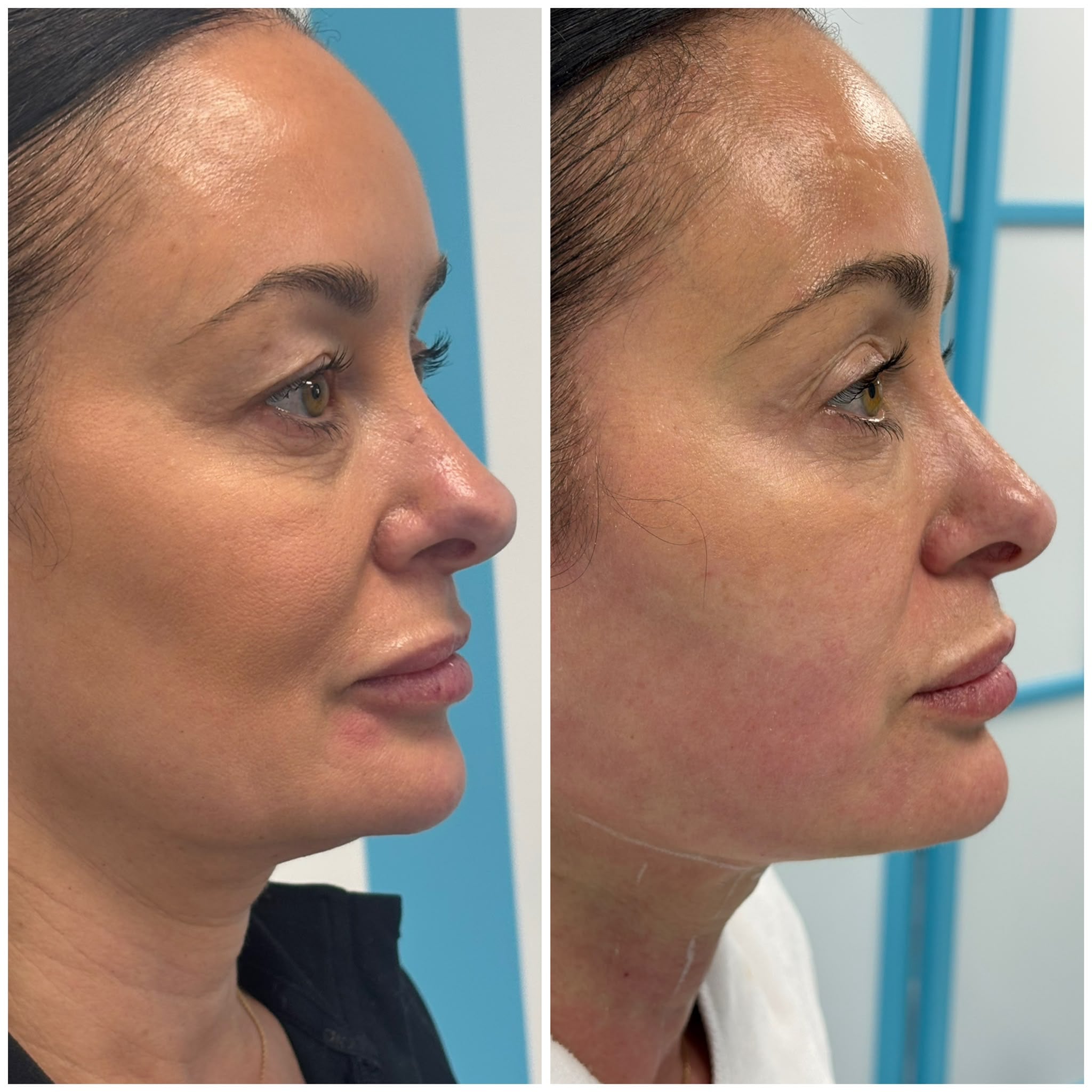Full Face, Jowls & Neck