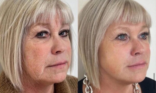 Wrinkles & Fine Lines